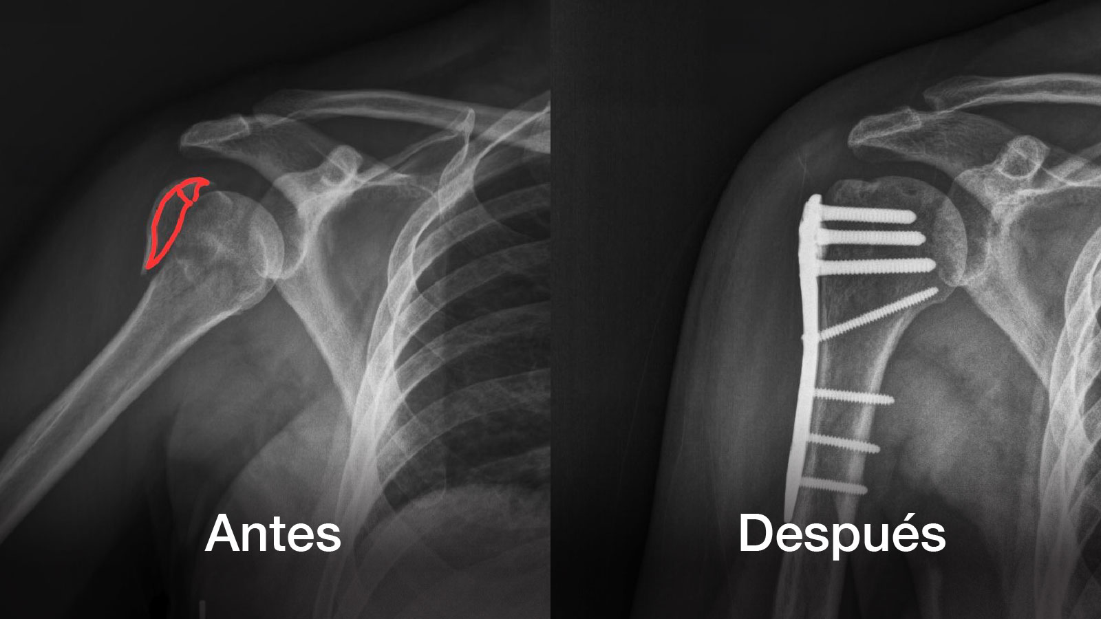 espina bífida oculta rayos x